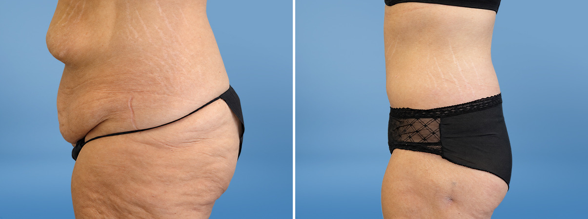 patient-39792-tummy-tuck-before-after