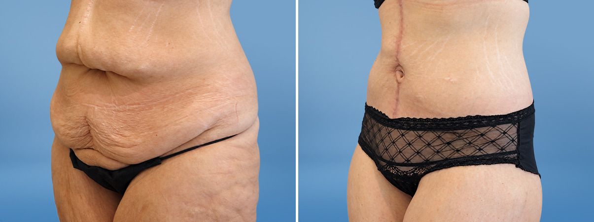 patient-39792-tummy-tuck-before-after