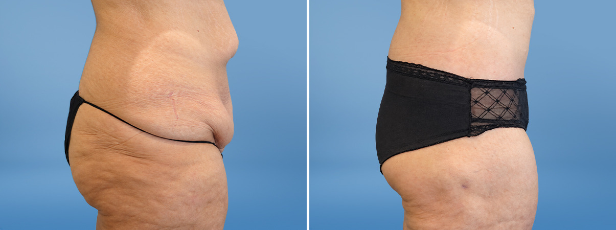 patient-39792-tummy-tuck-before-after
