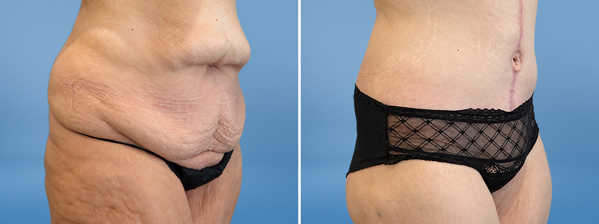 patient-39792-tummy-tuck-before-after