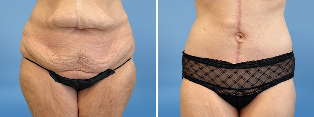 patient-39792-tummy-tuck-before-after