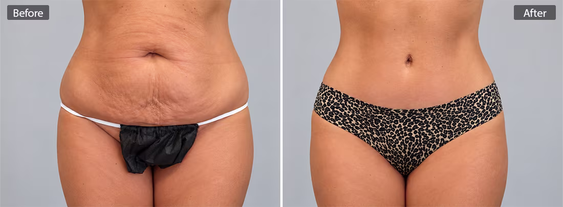 Before & After photo