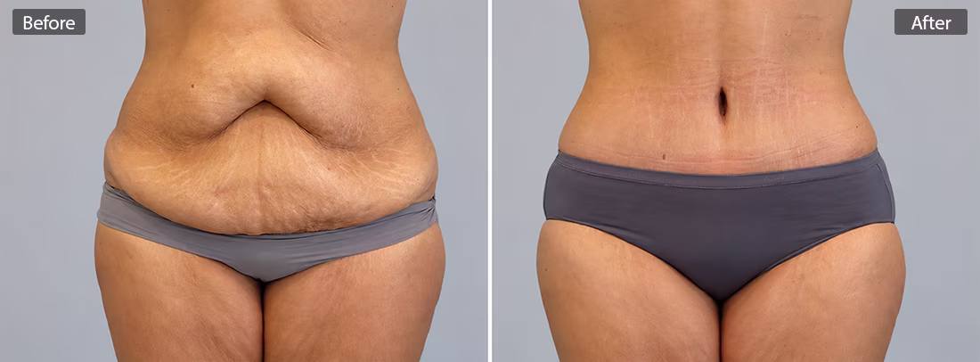 Before & After photo