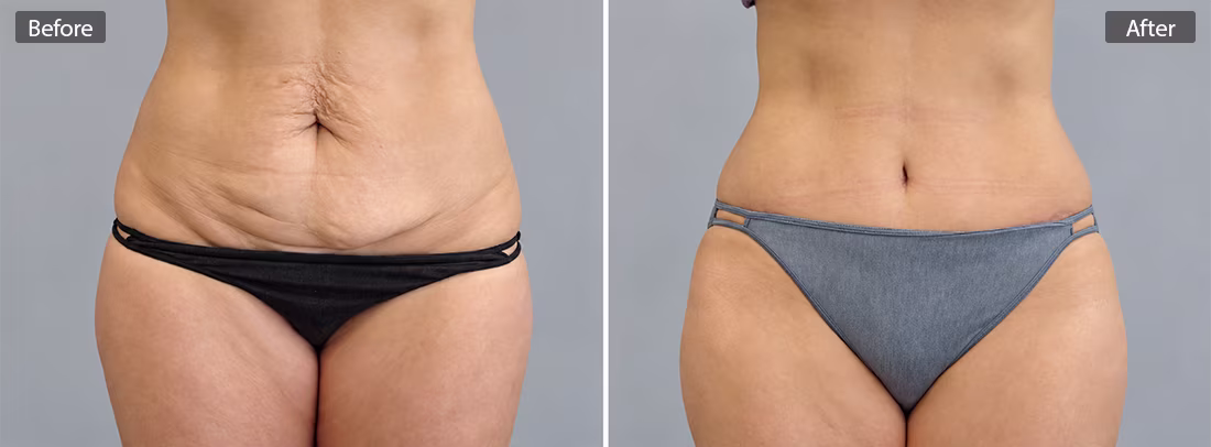 Before & After photo